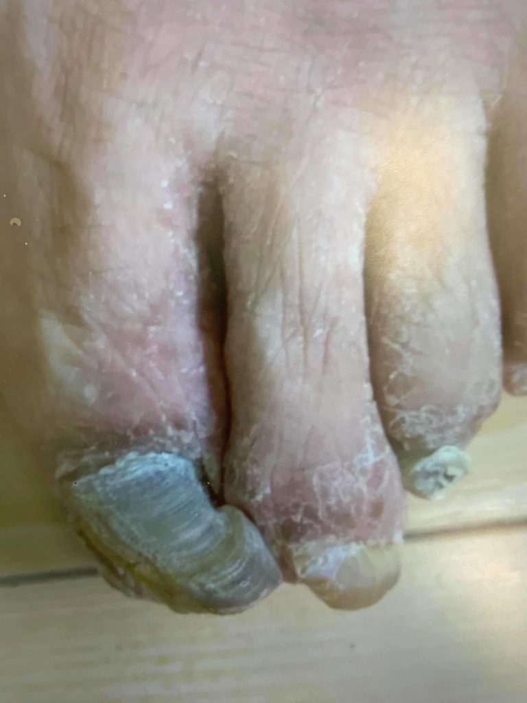 爪が厚くなり変形する病気、肥厚爪(爪甲鉤彎症)について