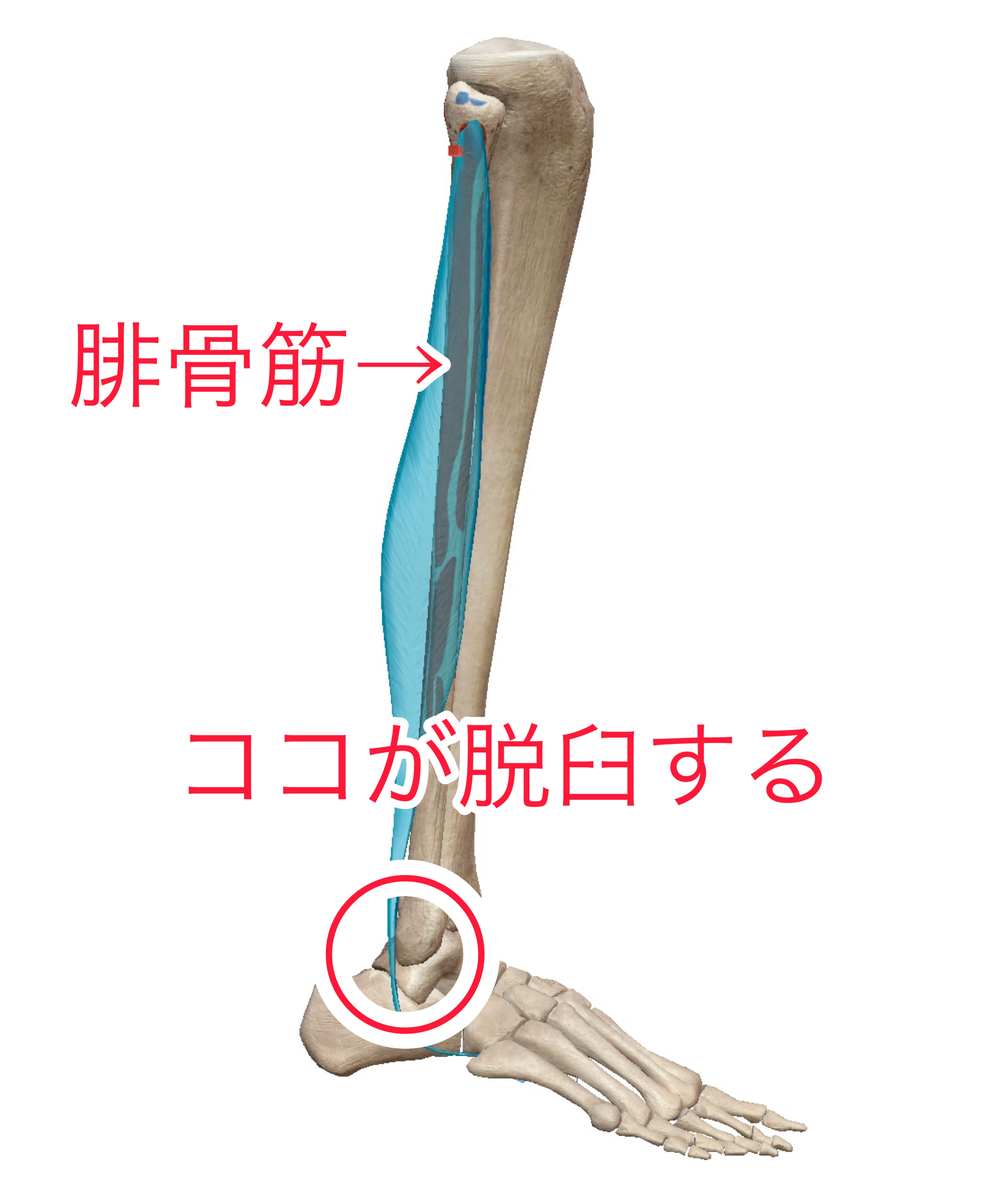 腓骨筋腱脱臼とは 腓骨筋腱脱臼といえば新宿足改善センターへ