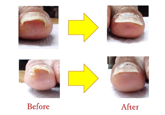 直角に曲がって、激痛の出ていた爪が良くなりました