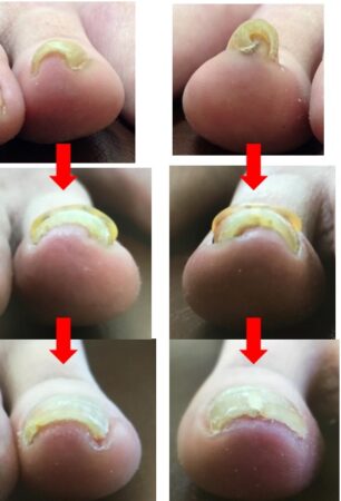 渦巻き状のひどい巻き爪でしたが今では見違えるようにきれいになりました！